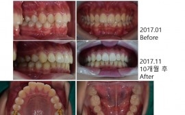 [인천용현점] 교정치료 전후(10...