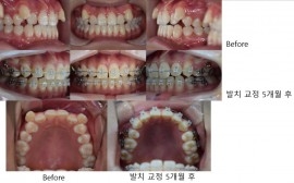 [인천용현점] 발치교정 5개월 ...